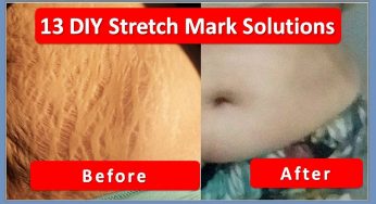 How to Get Rid of Stretch Marks Fast