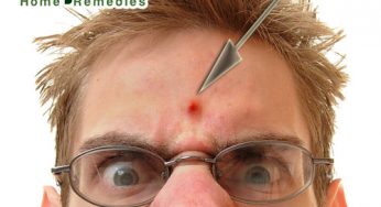 How to Get Rid of Pimples Fast